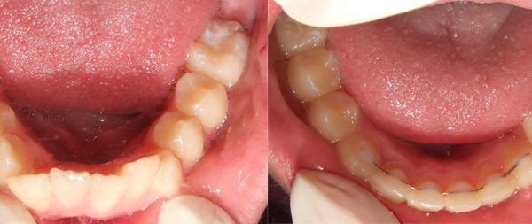 Case 2 - Lower Teeth Moving Backwards Corrected by Orthodontics in Toowoomba