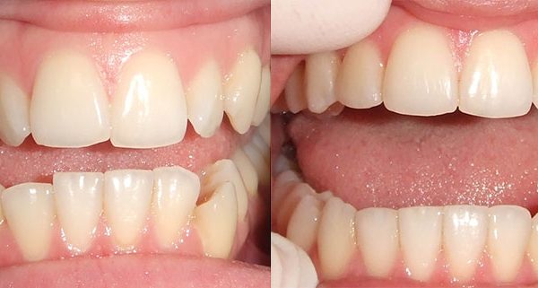 Case 4 - Misaligned Teeth on the Upper and Lower Corrected using Invisalign by a Orthodontics in Toowoomba