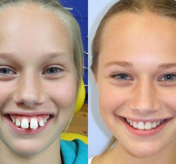 Kid with Teeth Problem Solve by Orthodontics in Toowoomba
