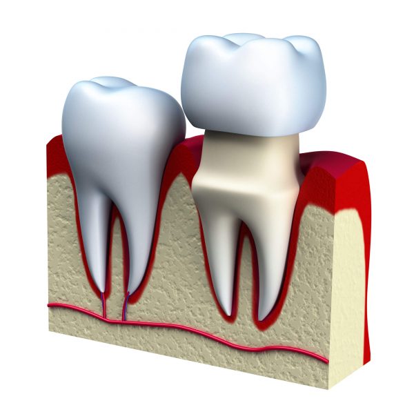 Dental Crowns & Bridges